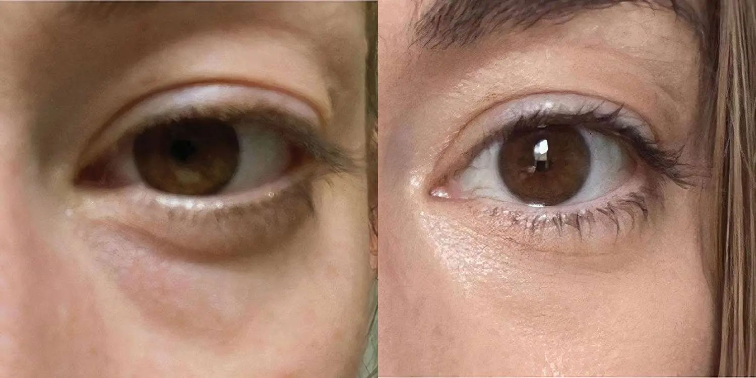 Eye Area Rejuvenation
